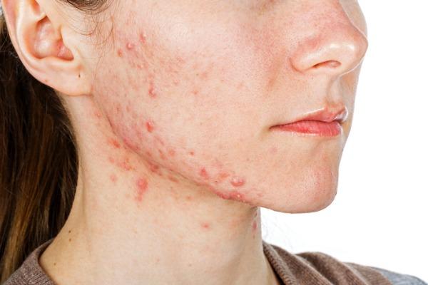 Understanding Hormonal Acne: Root Causes and⁢ Triggers