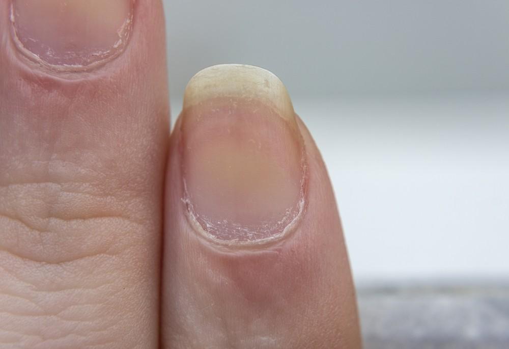 Transform Your Nails: Proven Treatments and Remedies for Yellowing