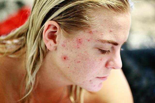 Understanding Seasonal Acne Triggers: How Weather Changes Impact Your Skin