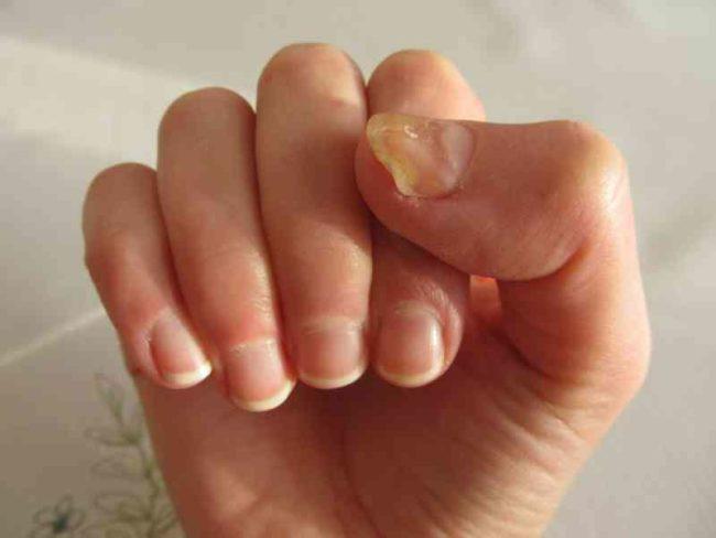 Understanding the Underlying Health Signals Behind Brittle Nails