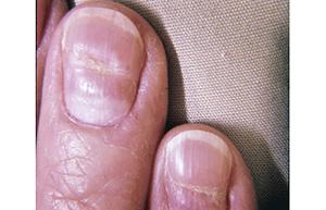 Spotting the Subtle Signs of Nail Deterioration: What to Look For